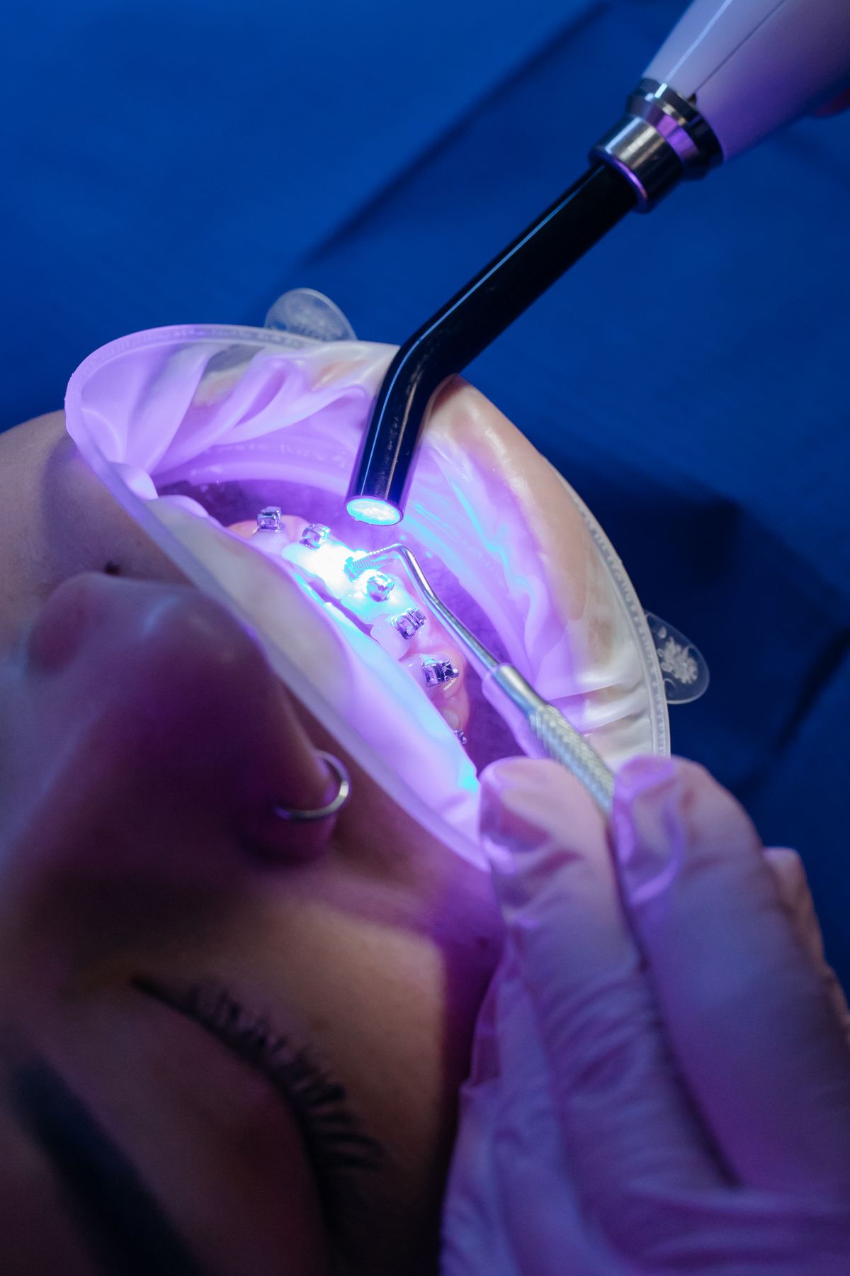 Dentist light-curing cosmetic bonding on a patient's teeth