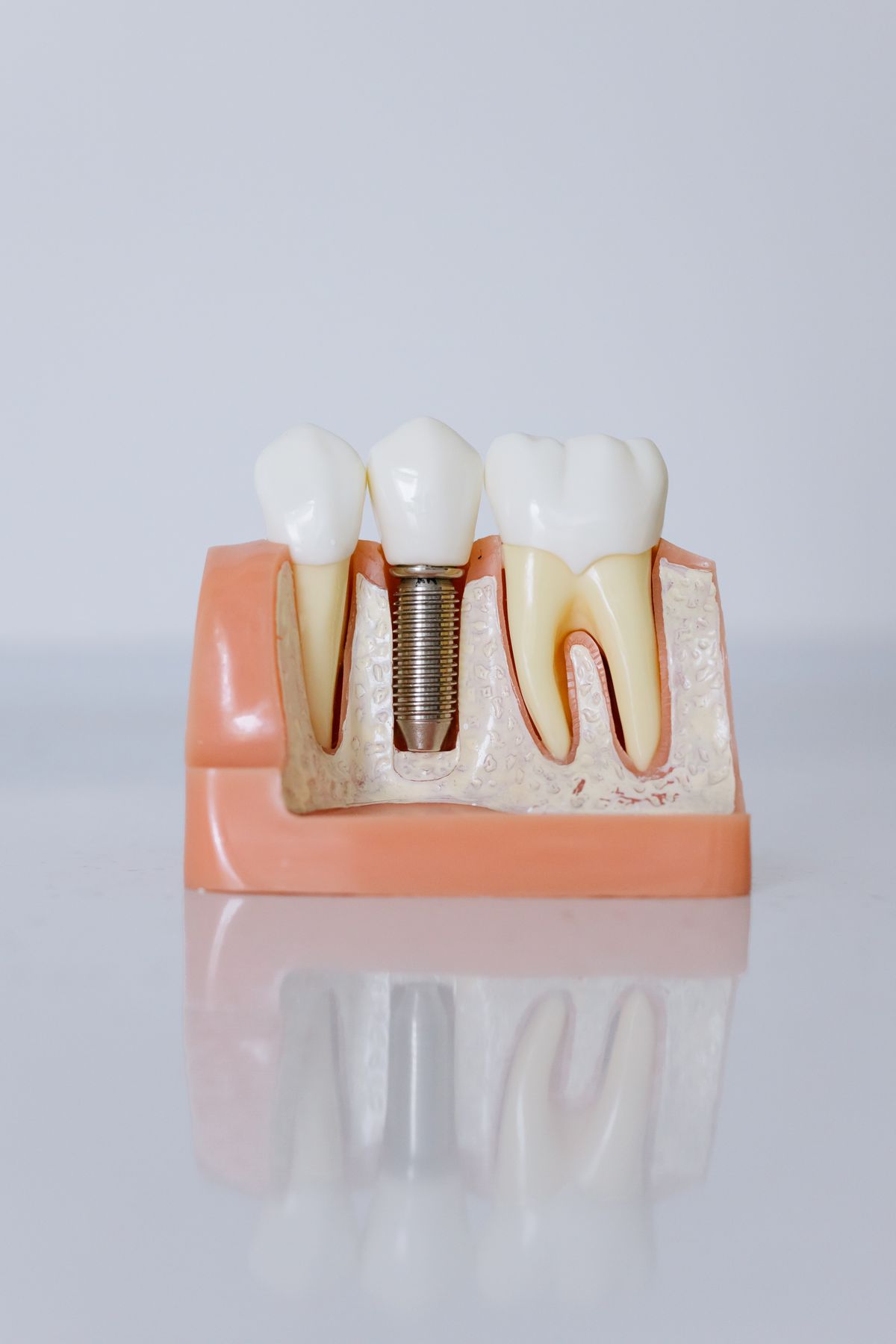 Model of a dental implant beside natural teeth